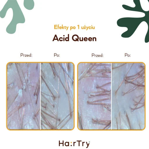 HairTry - Acid Queen - Trychologiczny Peeling Kwasowy do Skóry Głowy - 100ml