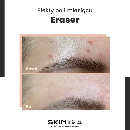 SkinTra - Eraser - Serum na Przebarwienia z Witaminą C 10% - 30ml