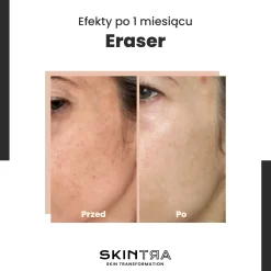 SkinTra - Eraser - Serum na Przebarwienia z Witaminą C 10% - 30ml