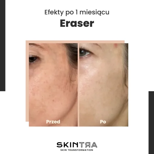 SkinTra - Eraser - Serum na Przebarwienia z Witaminą C 10% - 30ml