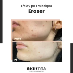 SkinTra - Eraser - Serum na Przebarwienia z Witaminą C 10% - 30ml