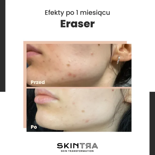 SkinTra - Eraser - Serum na Przebarwienia z Witaminą C 10% - 30ml